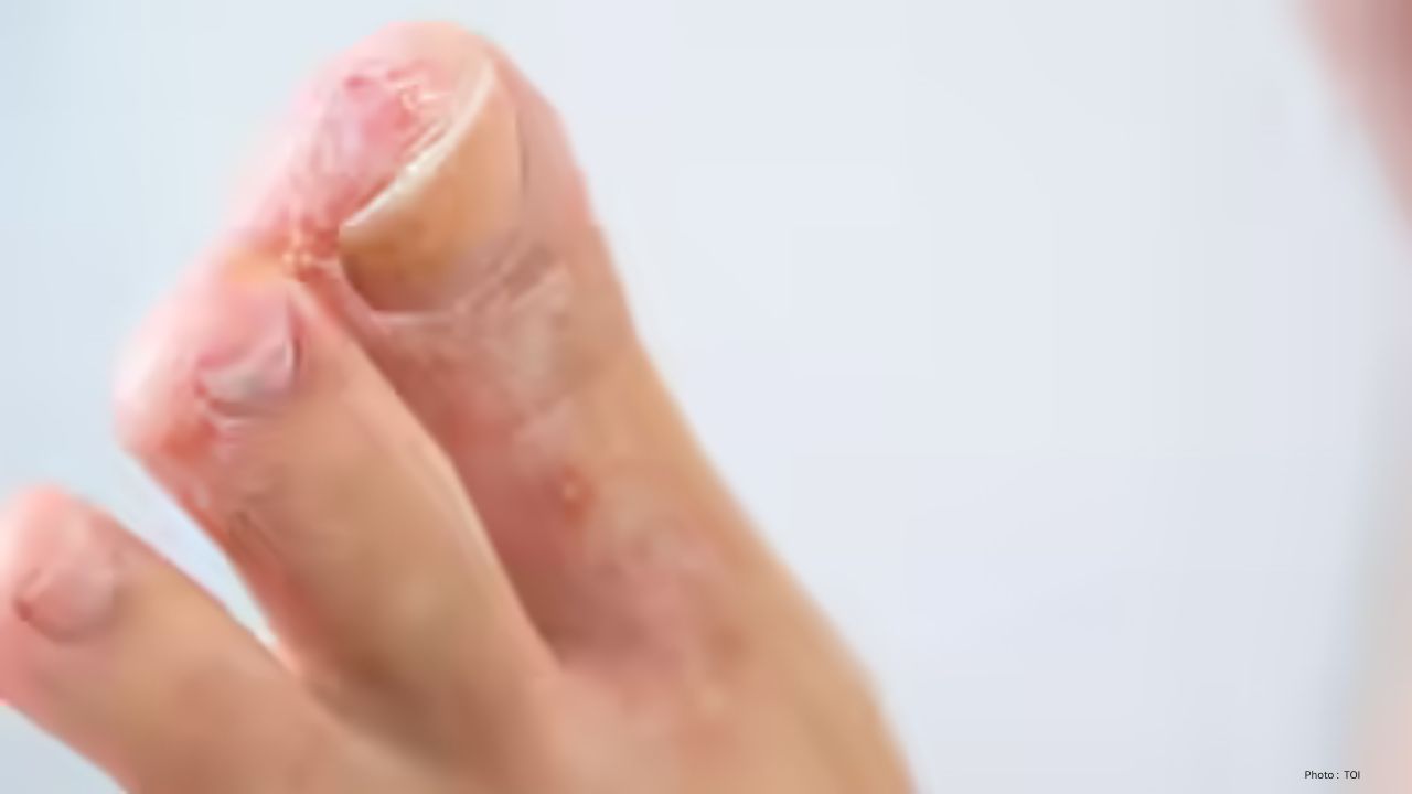 Doctors Share 10 Gentle Home Remedies to Soothe Athlete’s Foot