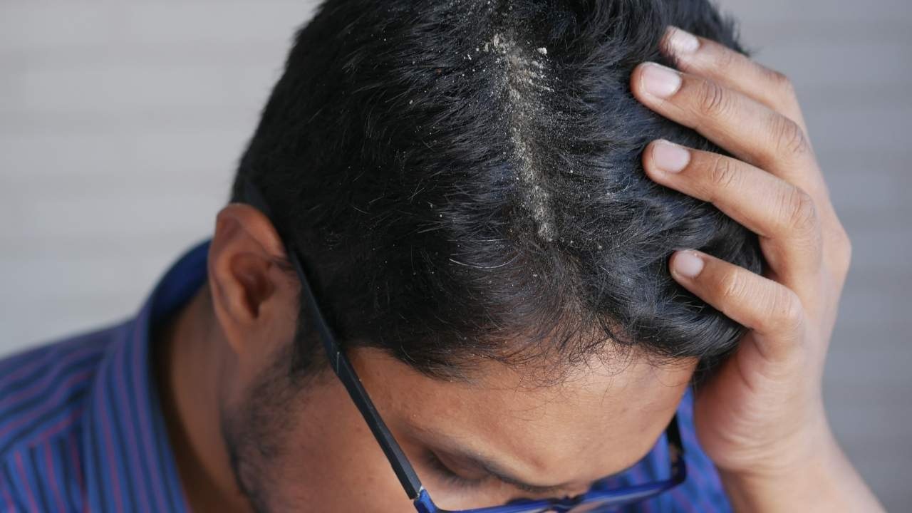 Banish Winter Dandruff: 4 Effective Tips for a Flake-Free Scalp