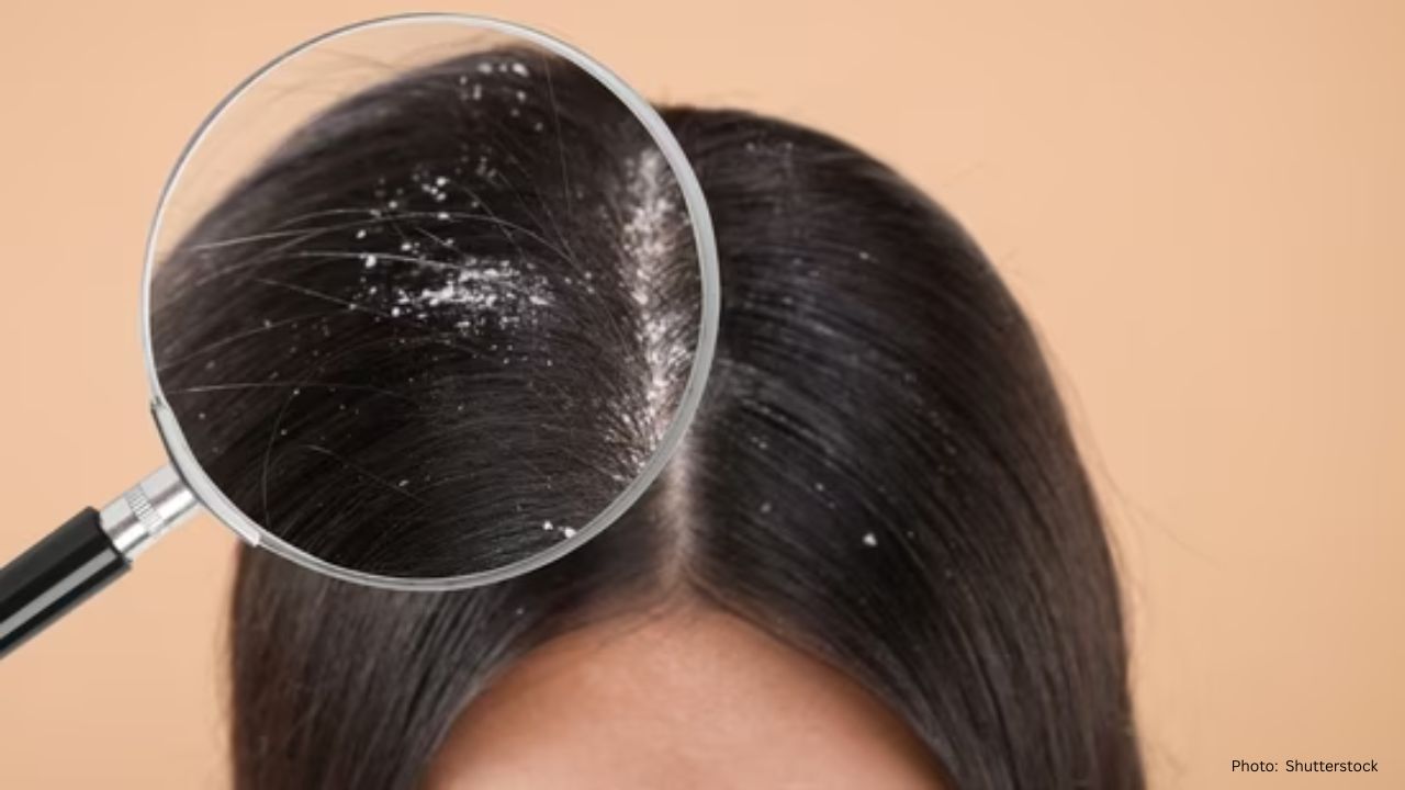 8 Natural Remedies for Dandruff as Suggested by a Dermatologist