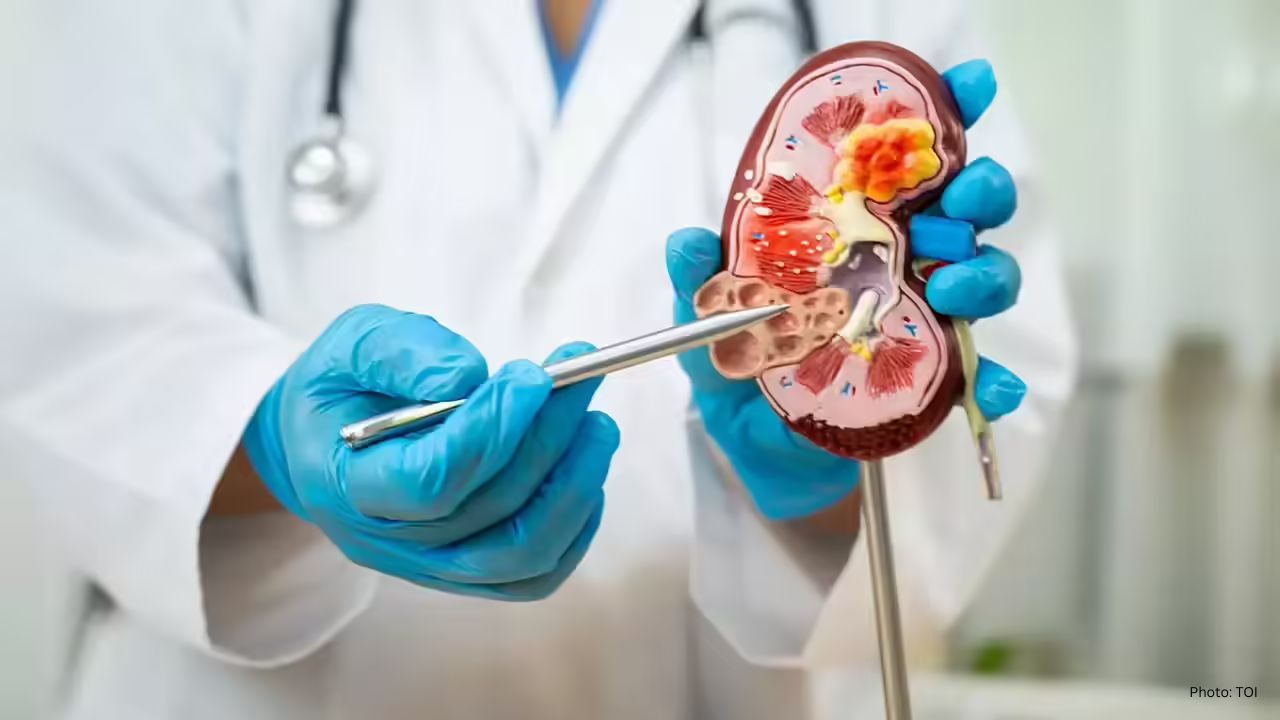 6 Essential Tips from a Doctor for Preventing Kidney Stones This Winter