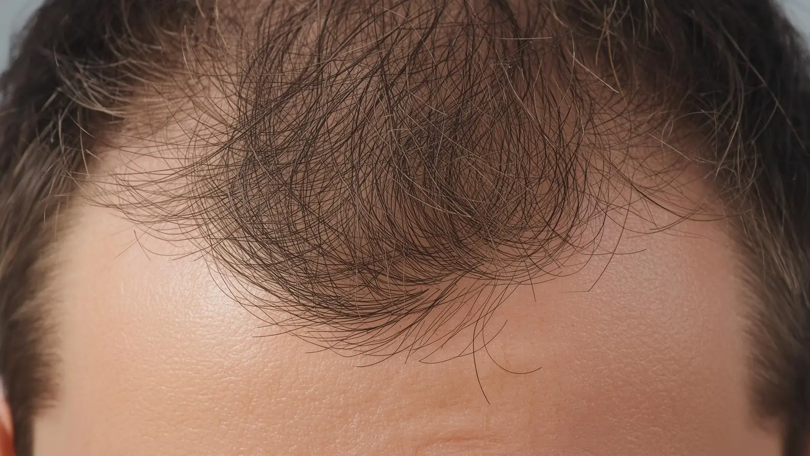 The Hidden Dangers of Daily Hair Styling and Tension Hairstyles