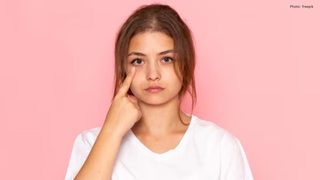 Exploring Dark Circles: Causes and Home Solutions