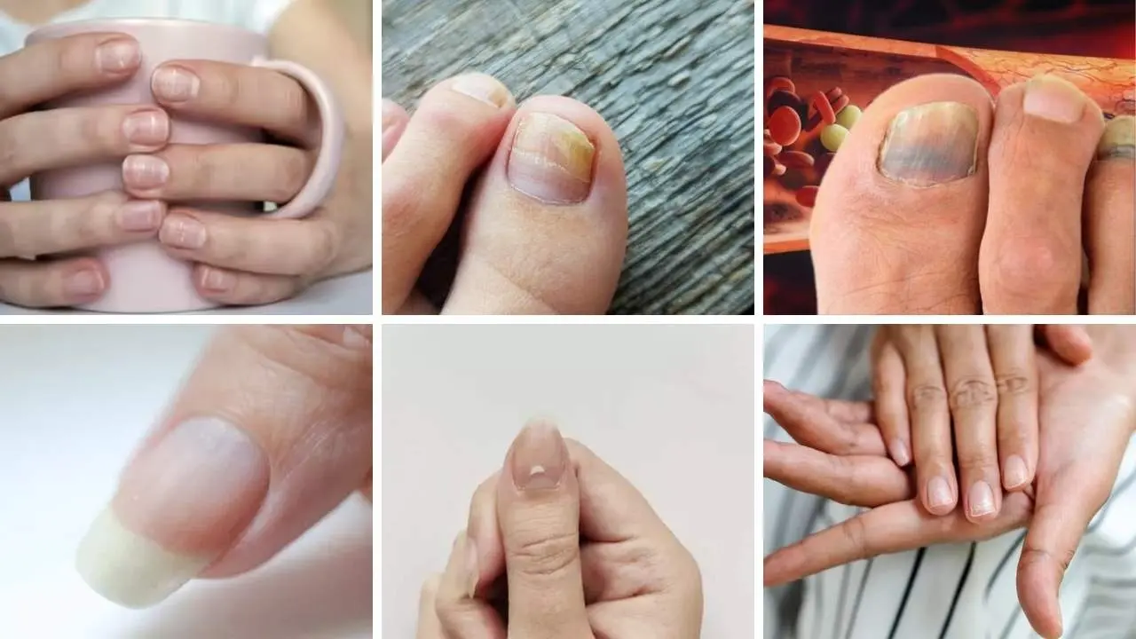 Seven Nail Changes That May Signal High Cholesterol