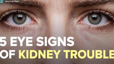 5 Eye Signs Indicating Potential Kidney Dysfunction